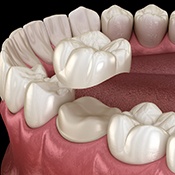 dental crown going on a tooth with a black surface