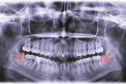 X-ray of bottom wisdom teeth marked in red