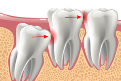 diagram of wisdom tooth pressing on other teeth