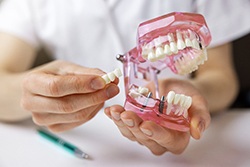 bridge held up next to a set of teeth with implant posts