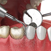 diagram of a dental cleaning