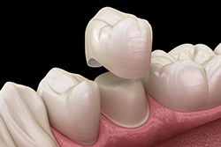 illustration of a dental crown going onto a tooth