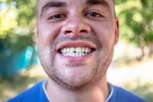 man outside showing his chipped front tooth